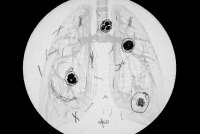 A photo illustration shows a black and white diagram of lungs superimposed over an old chromolithograph illustration of tuberculosis bacteria. The illustration in bordered by a dark black circle.